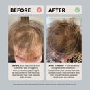 ACTIIV Remedy Dandruff Trio Limited Edition
