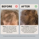 ACTIIV Remedy Dandruff Trio Limited Edition