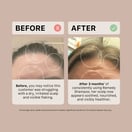 ACTIIV Remedy Dandruff Trio Limited Edition